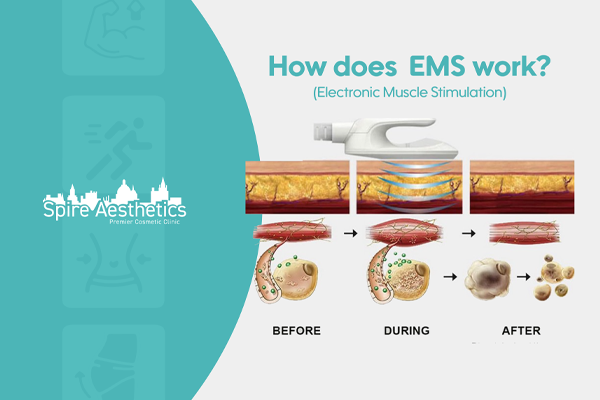 EMS treatment for post pregnancy weight loss treatment Witley