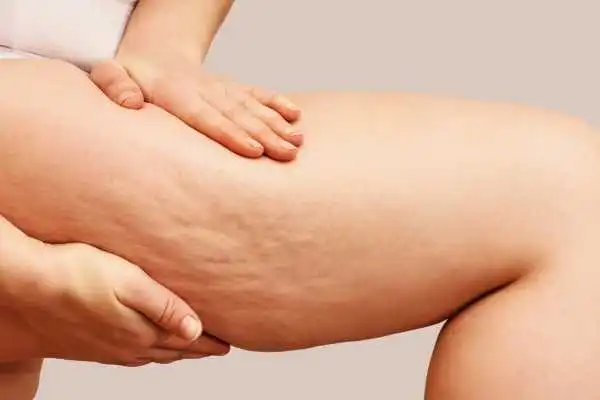 Image of woman showing leg with cellulite Witley
