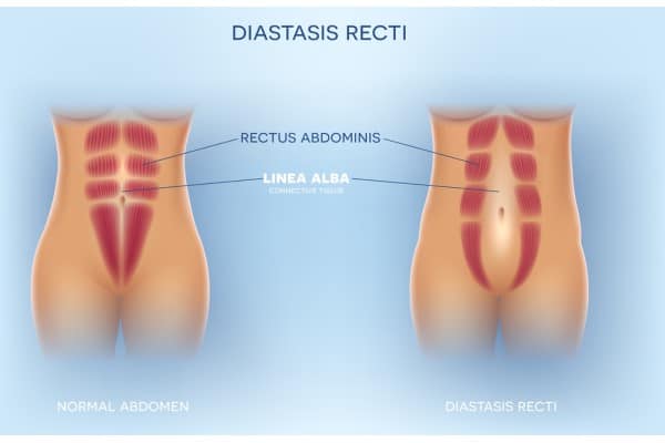 How Does Non-Surgical Treatment Help With Loose Skin, Weak Abdominal Muscles and Post-Pregnancy Changes Witley?
