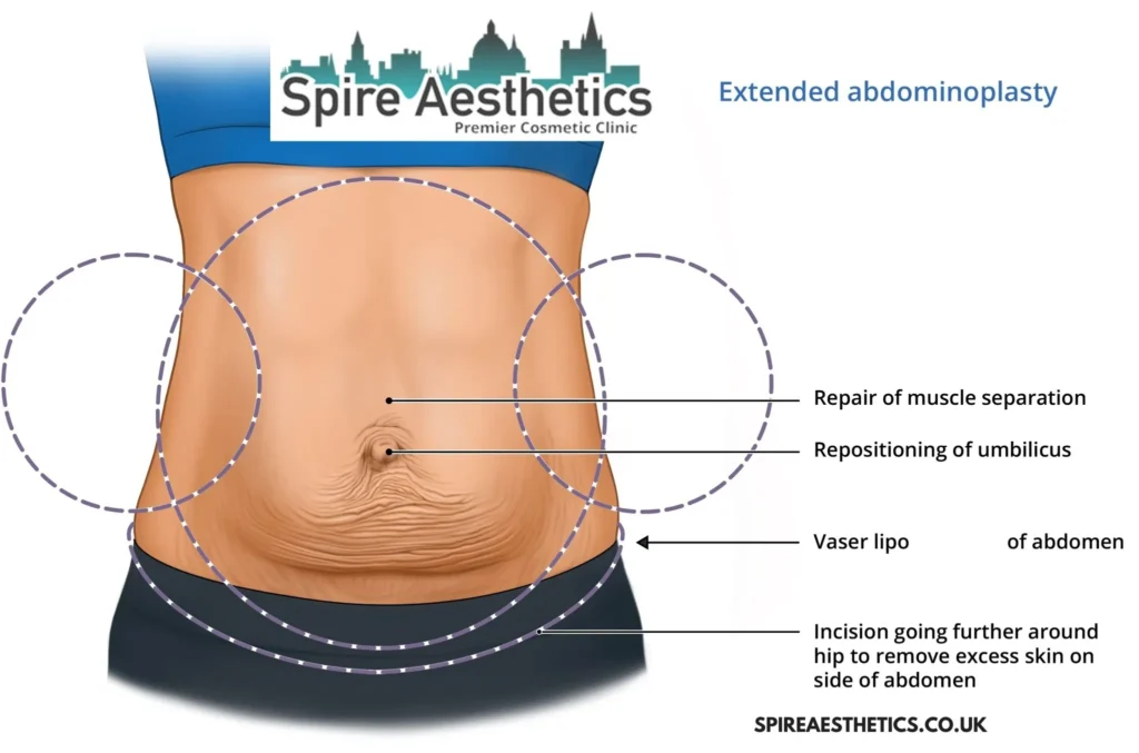 Understanding Loose Skin After Gastric Band Witley Surgery and HIFU Treatment 