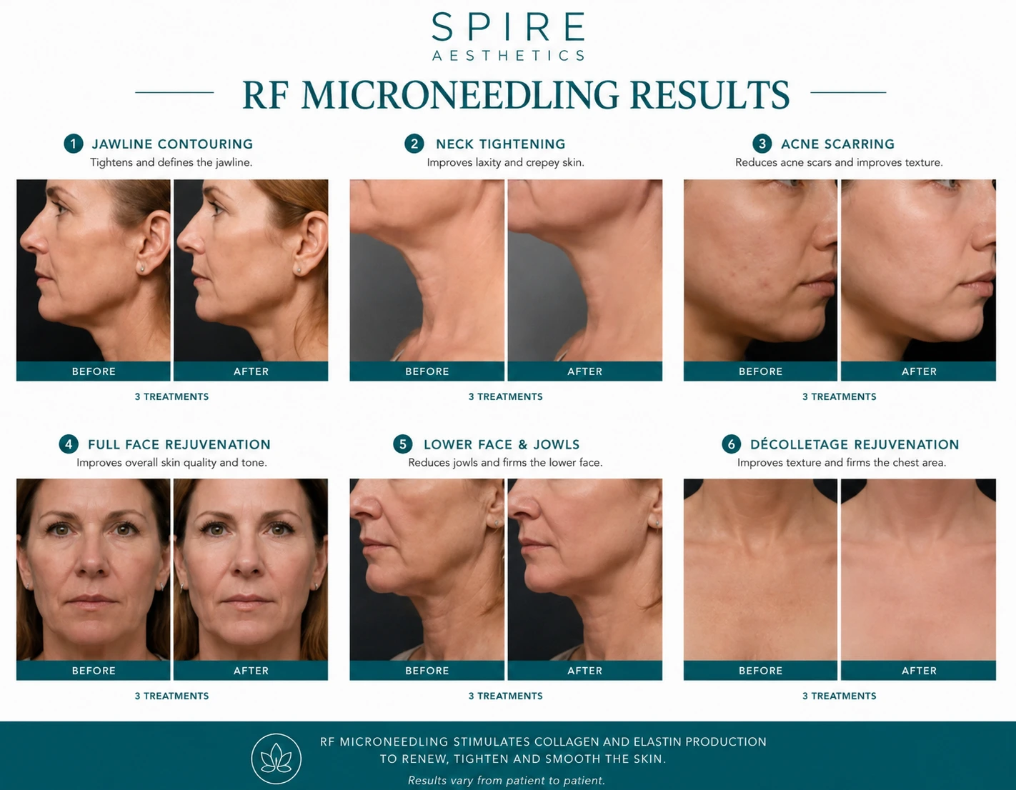 RF Microneedling Skin tightening Witley results