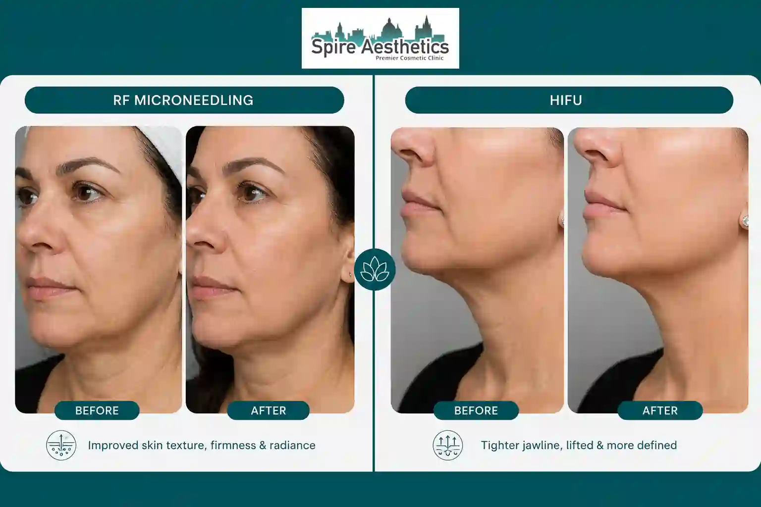 Can RF Microneedling and HIFU Be Combined Witley?
