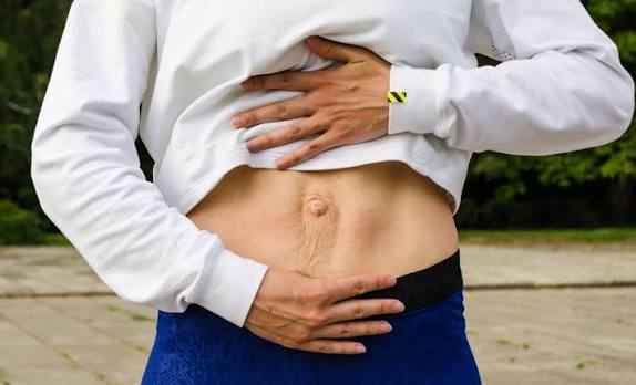 When Could Diastasis Recti Be the Missing Piece of the Puzzle Witley?