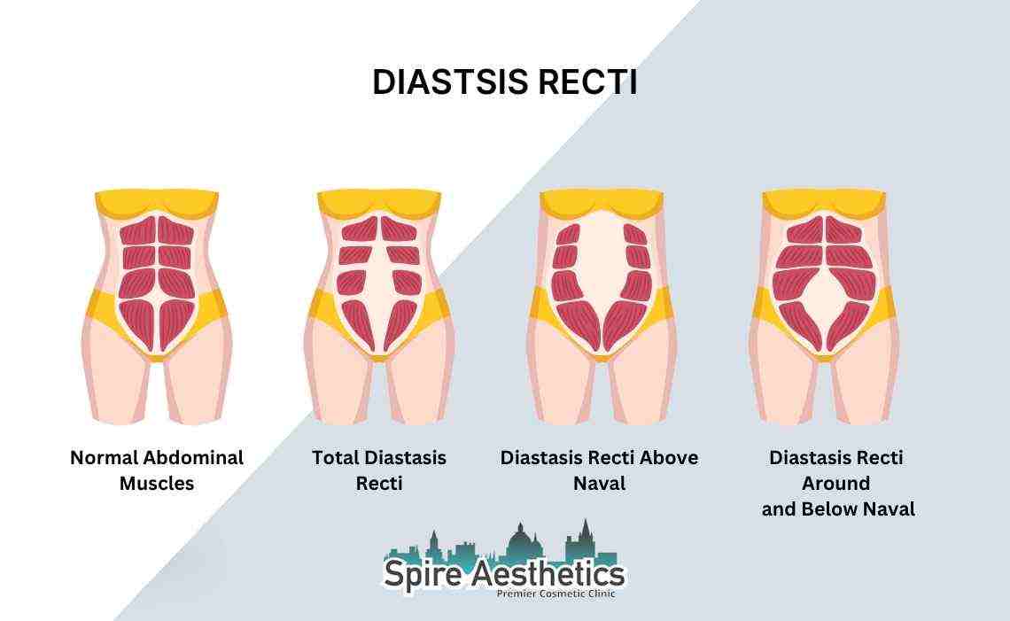 Is Non-Surgical Diastasis Recti Treatment Right for You? Common Concerns Answered Witley
